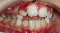 Open Bite Malocclusions - Some teeth do not meet