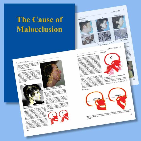 The Cause and Cure of Malocclusion - Hardback Book