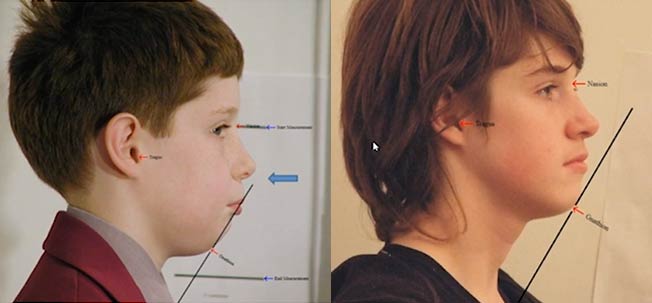 Gnathiometer before and afetr example picture