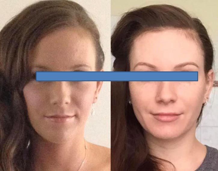 Image showing affect of correcting tongue to cheek